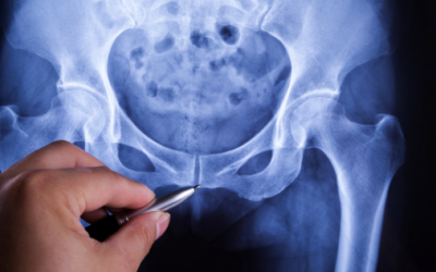 Can a Chiropractor Help With a Tailbone Injury?