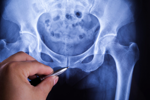 Can a Chiropractor Help With a Tailbone Injury?